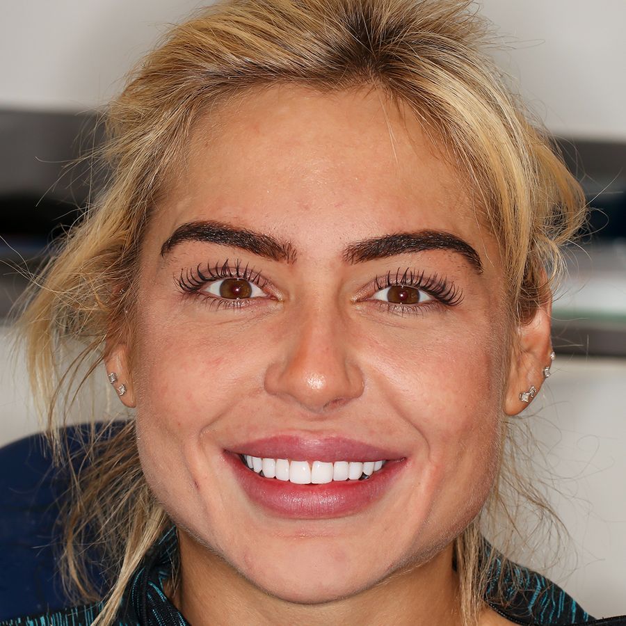 composite veneers after - 3dental